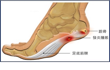 怎麼判斷是不是足底筋膜炎？有哪些症狀？初期該怎麼處理？